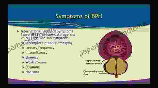 Symptoms Of Benign Prostate Hypertrophy Benign Prostate Hypetrophy Prostate Cancer Cure: Understanding Prostate Changes