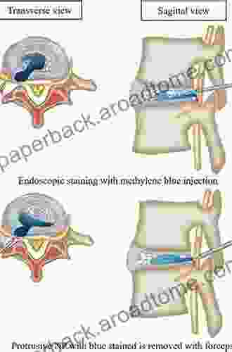 Percutaneous Lumbar Discectomy